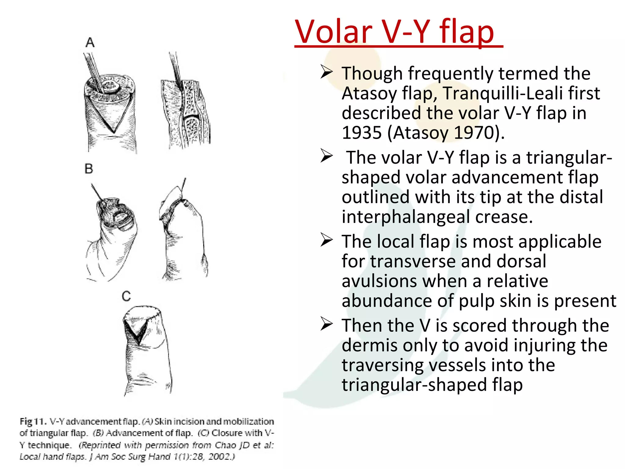 Volar V-Y flap
  Though frequently termed the
   Atasoy flap, Tranquilli-Leali first
   described the volar V-Y flap in
   1935 (Atasoy 1970).
  The volar V-Y flap is a triangular-
   shaped volar advancement flap
   outlined with its tip at the distal
   interphalangeal crease.
  The local flap is most applicable
   for transverse and dorsal
   avulsions when a relative
   abundance of pulp skin is present
  Then the V is scored through the
   dermis only to avoid injuring the
   traversing vessels into the
   triangular-shaped flap
 
