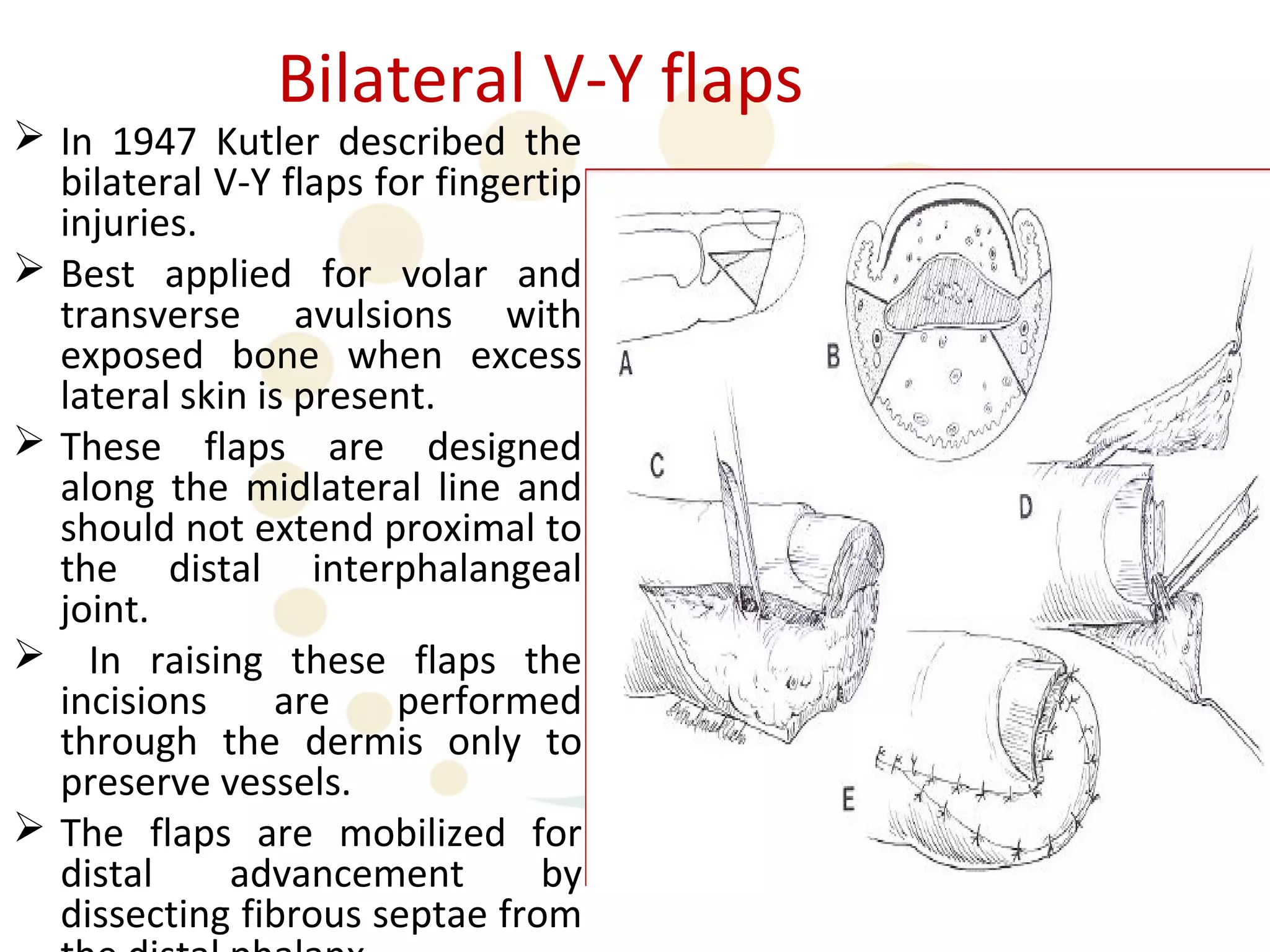 Bilateral V-Y flaps
 In 1947 Kutler described the
  bilateral V-Y flaps for fingertip
  injuries.
 Best applied for volar and
  transverse avulsions with
  exposed bone when excess
  lateral skin is present.
 These flaps are designed
  along the midlateral line and
  should not extend proximal to
  the distal interphalangeal
  joint.
 In raising these flaps the
  incisions     are    performed
  through the dermis only to
  preserve vessels.
 The flaps are mobilized for
                                      •The disadvantages of Kutler flaps
  distal     advancement        by    include partial or complete flap
  dissecting fibrous septae from
 