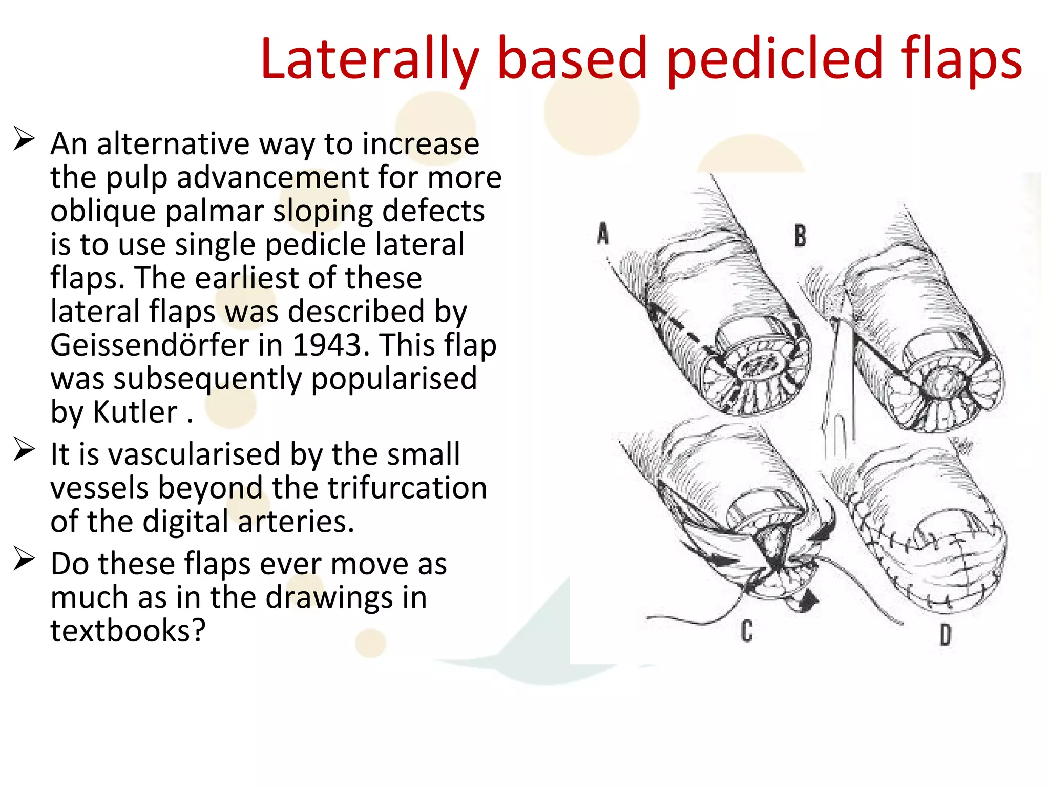 Laterally based pedicled flaps
 An alternative way to increase
  the pulp advancement for more
  oblique palmar sloping defects
  is to use single pedicle lateral
  flaps. The earliest of these
  lateral flaps was described by
  Geissendörfer in 1943. This flap
  was subsequently popularised
  by Kutler .
 It is vascularised by the small
  vessels beyond the trifurcation
  of the digital arteries.
 Do these flaps ever move as
  much as in the drawings in
  textbooks?
 