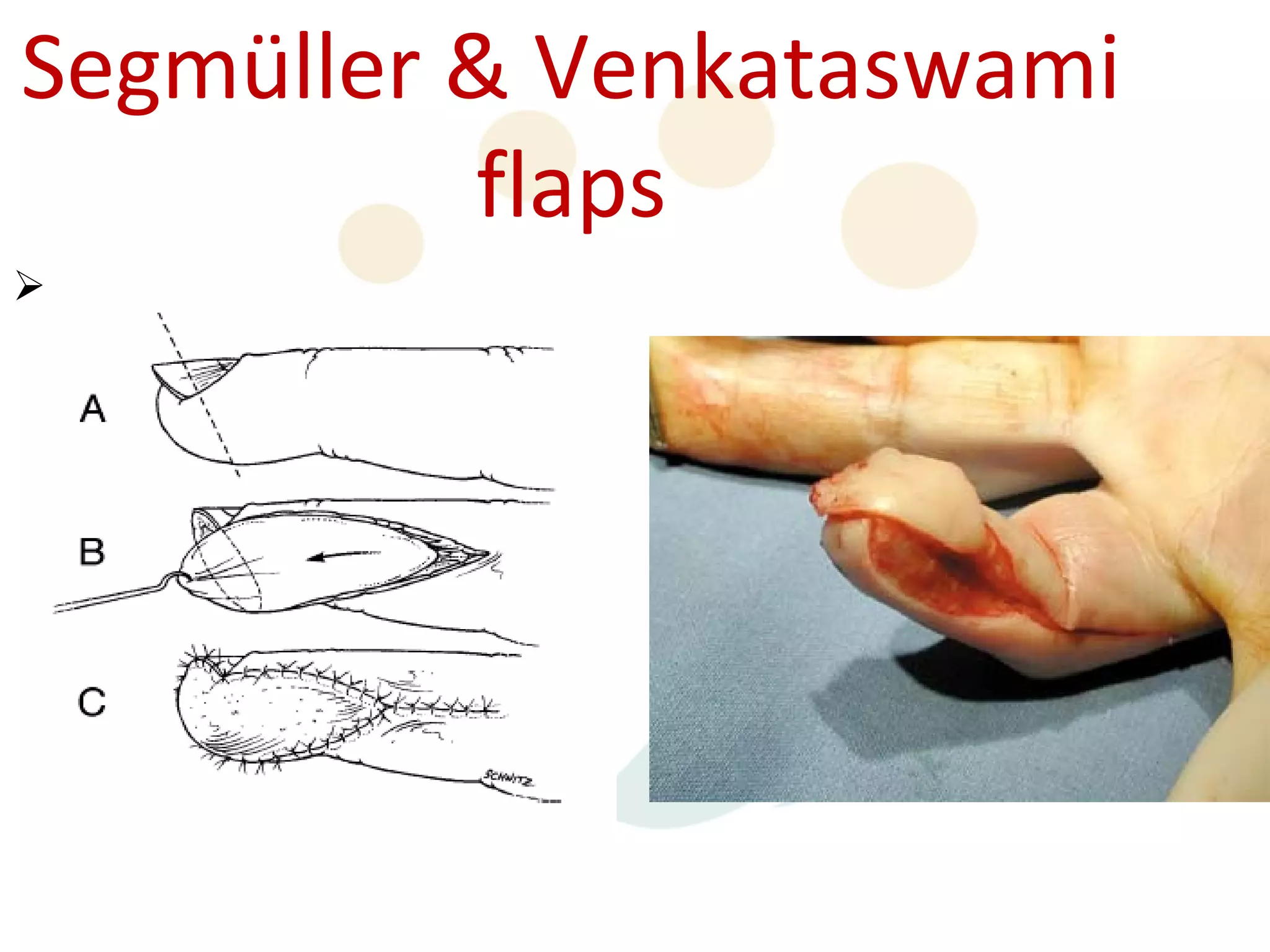 Segmüller & Venkataswami
          flaps

 