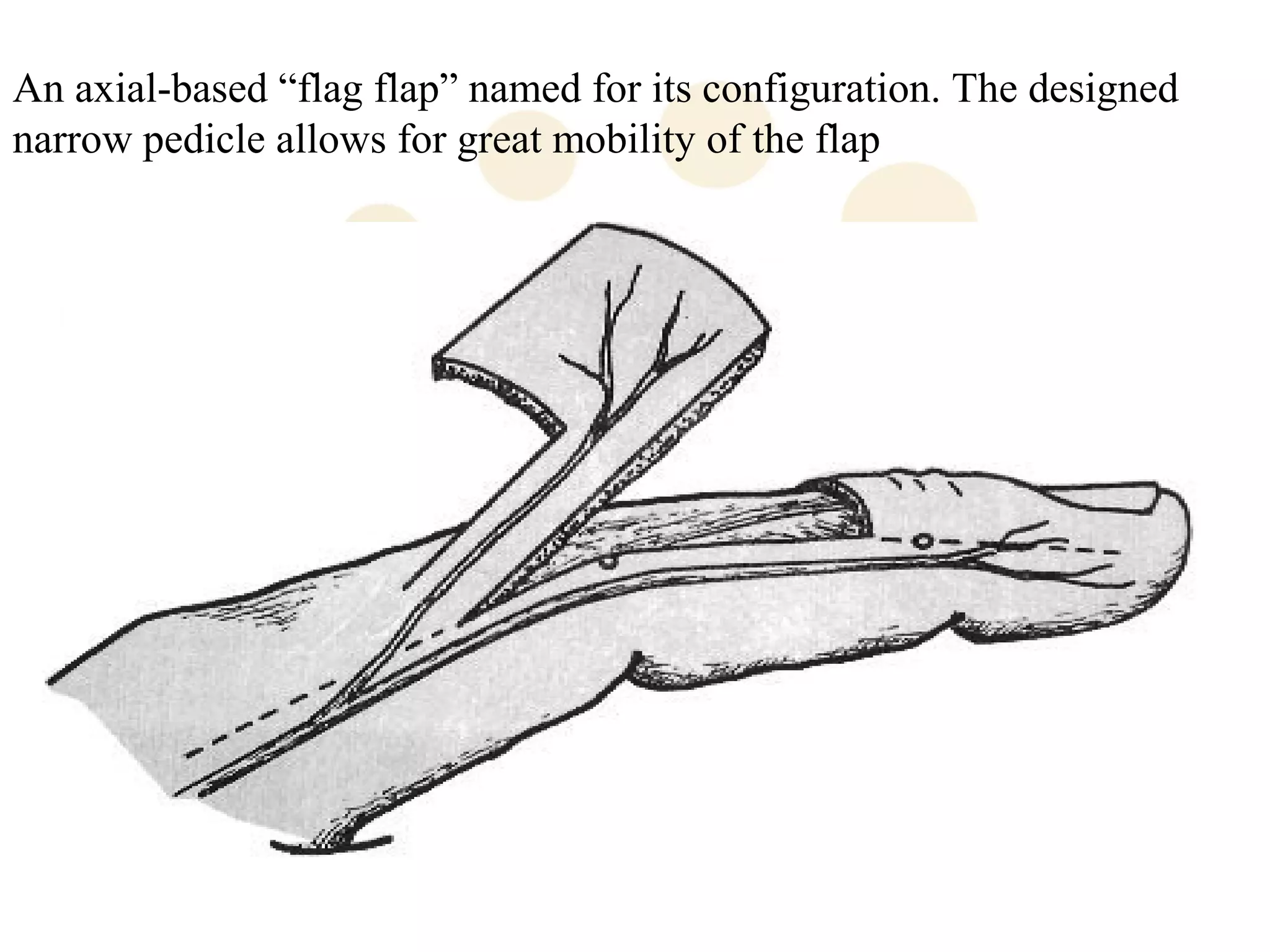 An axial-based “flag flap” named for its configuration. The designed
narrow pedicle allows for great mobility of the flap
 