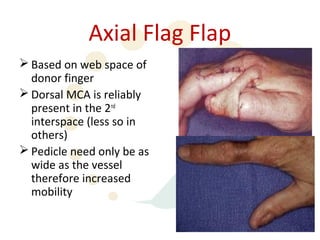 Axial Flag Flap
 Based on web space of
  donor finger
 Dorsal MCA is reliably
  present in the 2nd
  interspace (less so in
  others)
 Pedicle need only be as
  wide as the vessel
  therefore increased
  mobility
 