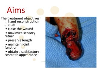 Aims
The treatment objectives
  in hand reconstruction
  are to:
   • close the wound
   • maximize sensory
  return
   • preserve length
   • maintain joint
  function
   • obtain a satisfactory
  cosmetic appearance
 