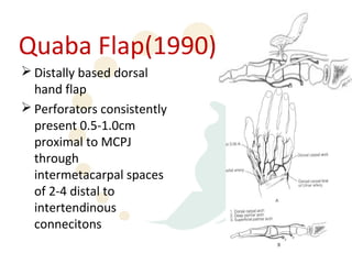 Quaba Flap(1990)
 Distally based dorsal
  hand flap
 Perforators consistently
  present 0.5-1.0cm
  proximal to MCPJ
  through
  intermetacarpal spaces
  of 2-4 distal to
  intertendinous
  connecitons
 