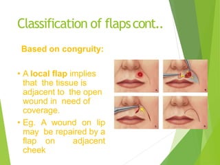 Flaps (2).pptx