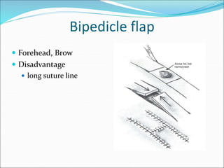 Flaps Basics and Important Leg Flaps and Trauma to Leg management | PPT