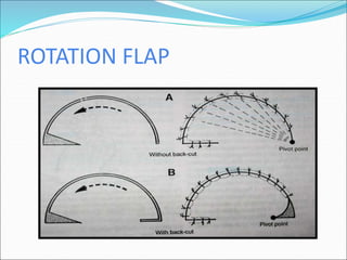 Flaps Basics and Important Leg Flaps and Trauma to Leg management | PPT