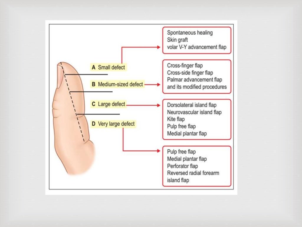 Flaps hand harsh amin