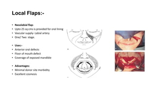 Flaps in Head and Neck powerpointpresentation.pptx
