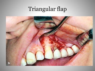 Triangular flap
 