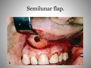 Semilunar flap.
 