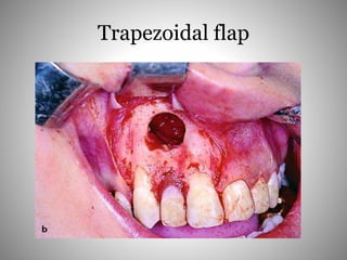 Trapezoidal flap
 