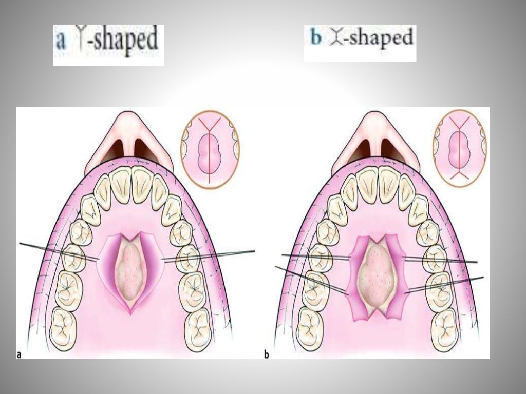 Flaps in oral surgery