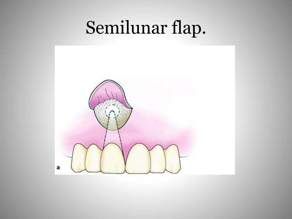 Flaps in oral surgery