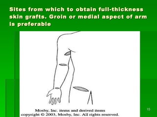 Sites from which to obtain full-thickness skin grafts. Groin or medial aspect of arm is preferable  