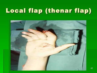 Local flap (thenar flap)  