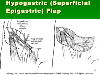 Hypogastric (Superficial Epigastric) Flap 