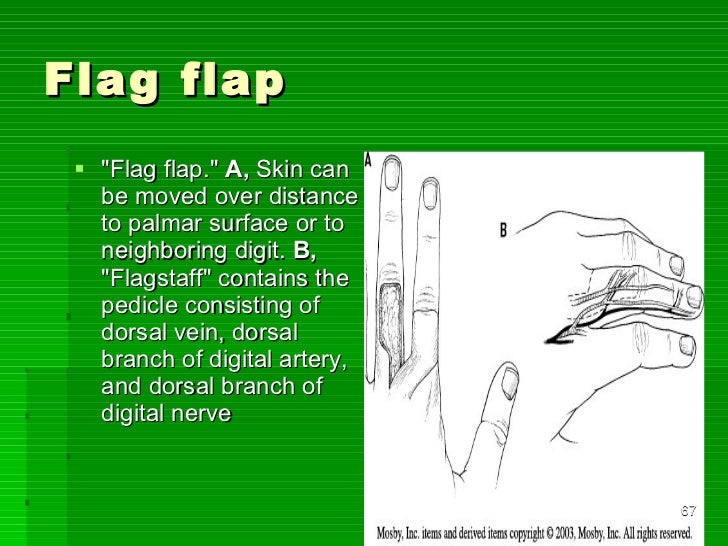 Flaps in orthopaedics