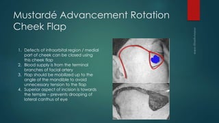 Flaps in otolaryngology | PPTX