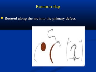 Flaps in plastic surgery | PPT