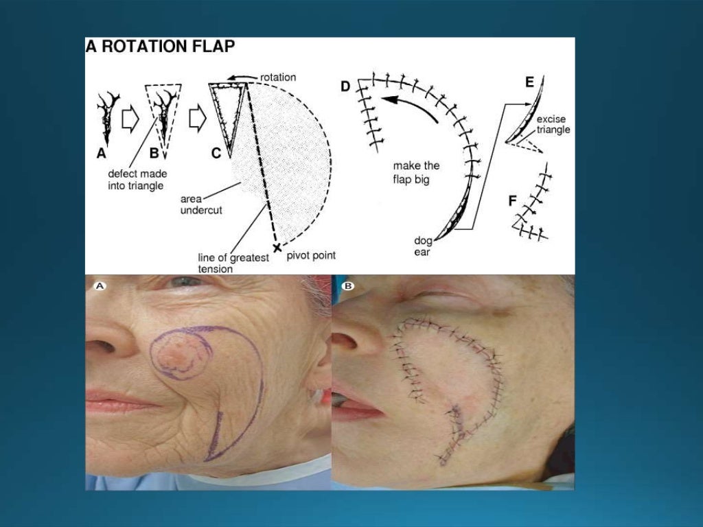 Flaps in surgery