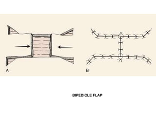 Flaps in surgery adesiyakan slideshare | PPTX