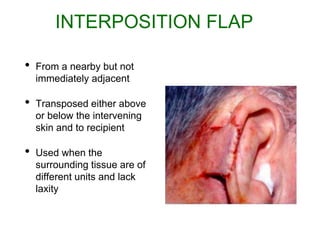 Interposition Flap Flaps in surgery adesiyakan slideshare | PPTX
