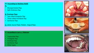 Triangular Flao MASTERING FLAPS IN ORAL & MAXILLOFACIAL SURGERY | PDF