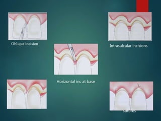 Interposition Flap Flap surgery | PPTX
