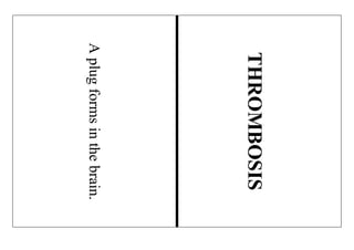 Aplugformsinthebrain.
THROMBOSIS
 