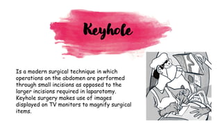 Is a modern surgical technique in which
operations on the abdomen are performed
through small incisions as opposed to the
larger incisions required in laparotomy.
Keyhole surgery makes use of images
displayed on TV monitors to magnify surgical
items.
Keyhole
 