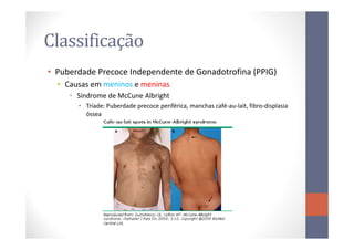 Classificação
• Puberdade Precoce Independente de Gonadotrofina (PPIG)
• Causas em meninos e meninas
• Síndrome de McCune Albright
• Tríade: Puberdade precoce periférica, manchas café-au-lait, fibro-displasia
óssea
 
