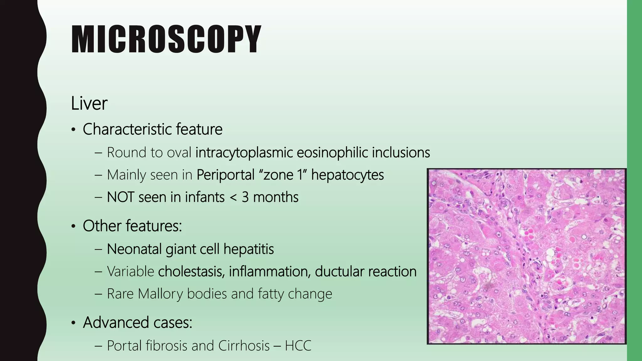 MICROSCOPY
Liver
• Characteristic feature
– Round to oval intracytoplasmic eosinophilic inclusions
– Mainly seen in Periportal “zone 1” hepatocytes
– NOT seen in infants < 3 months
• Other features:
– Neonatal giant cell hepatitis
– Variable cholestasis, inflammation, ductular reaction
– Rare Mallory bodies and fatty change
• Advanced cases:
– Portal fibrosis and Cirrhosis – HCC
 