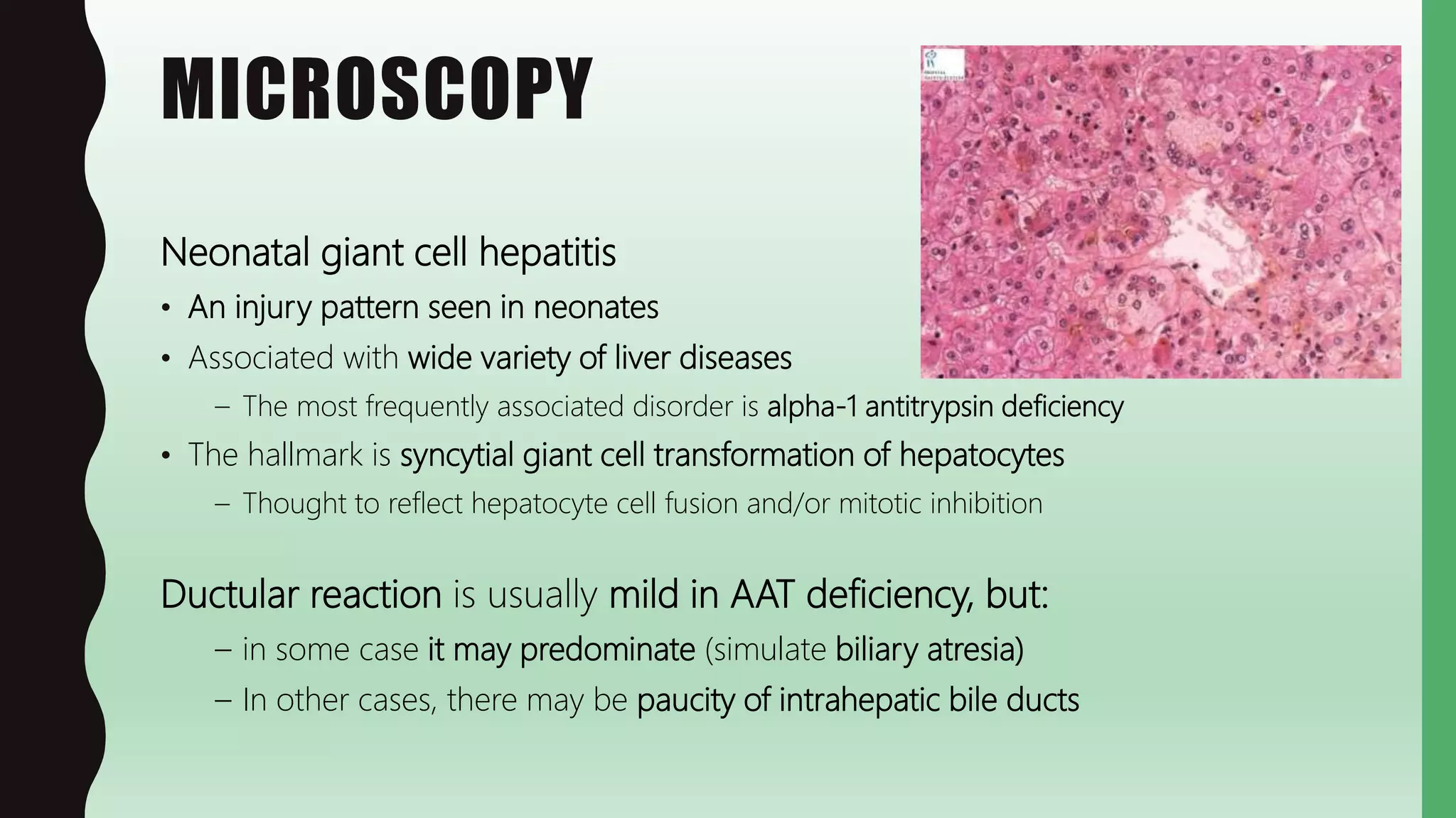 MICROSCOPY
Neonatal giant cell hepatitis
• An injury pattern seen in neonates
• Associated with wide variety of liver diseases
– The most frequently associated disorder is alpha-1 antitrypsin deficiency
• The hallmark is syncytial giant cell transformation of hepatocytes
– Thought to reflect hepatocyte cell fusion and/or mitotic inhibition
Ductular reaction is usually mild in AAT deficiency, but:
– in some case it may predominate (simulate biliary atresia)
– In other cases, there may be paucity of intrahepatic bile ducts
 