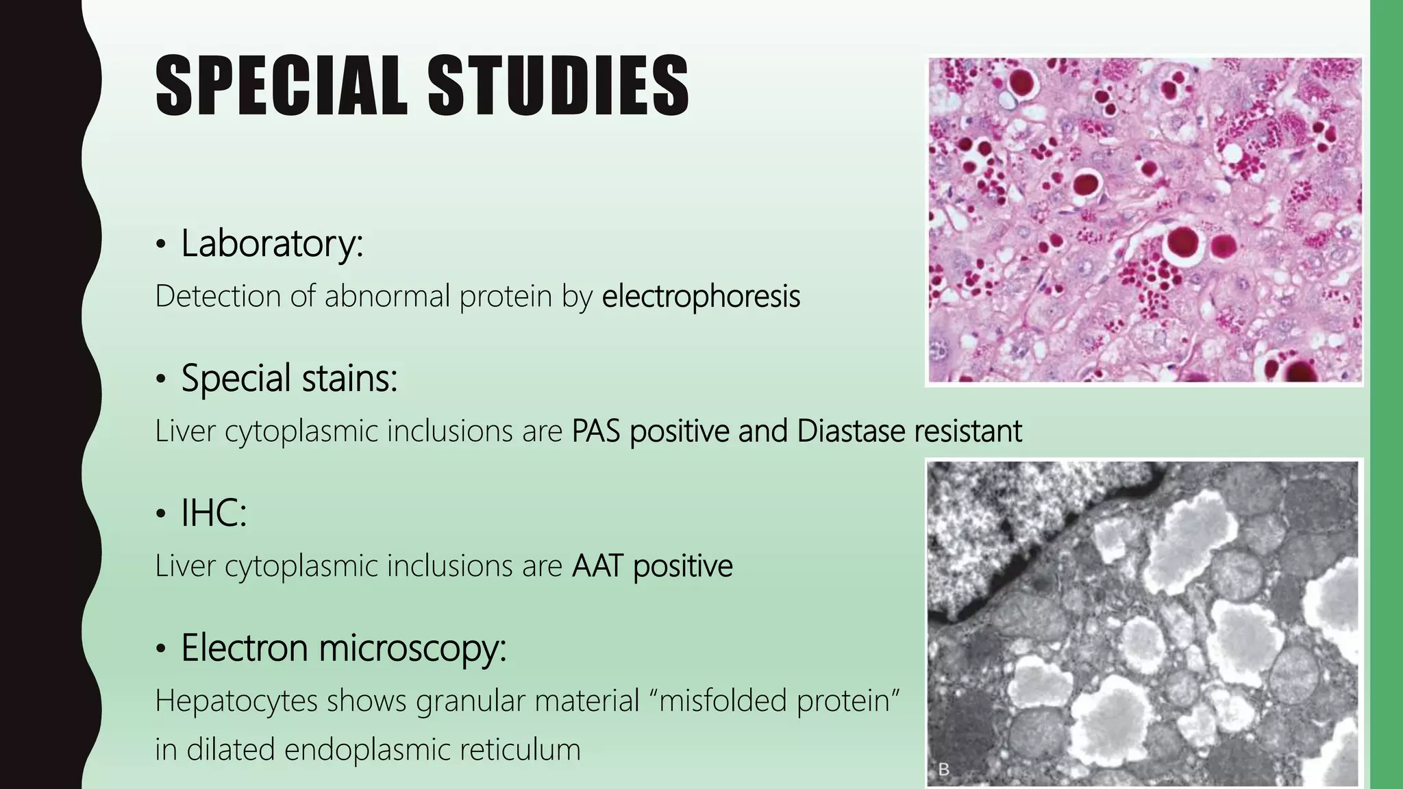 SPECIAL STUDIES
• Laboratory:
Detection of abnormal protein by electrophoresis
• Special stains:
Liver cytoplasmic inclusions are PAS positive and Diastase resistant
• IHC:
Liver cytoplasmic inclusions are AAT positive
• Electron microscopy:
Hepatocytes shows granular material “misfolded protein”
in dilated endoplasmic reticulum
 