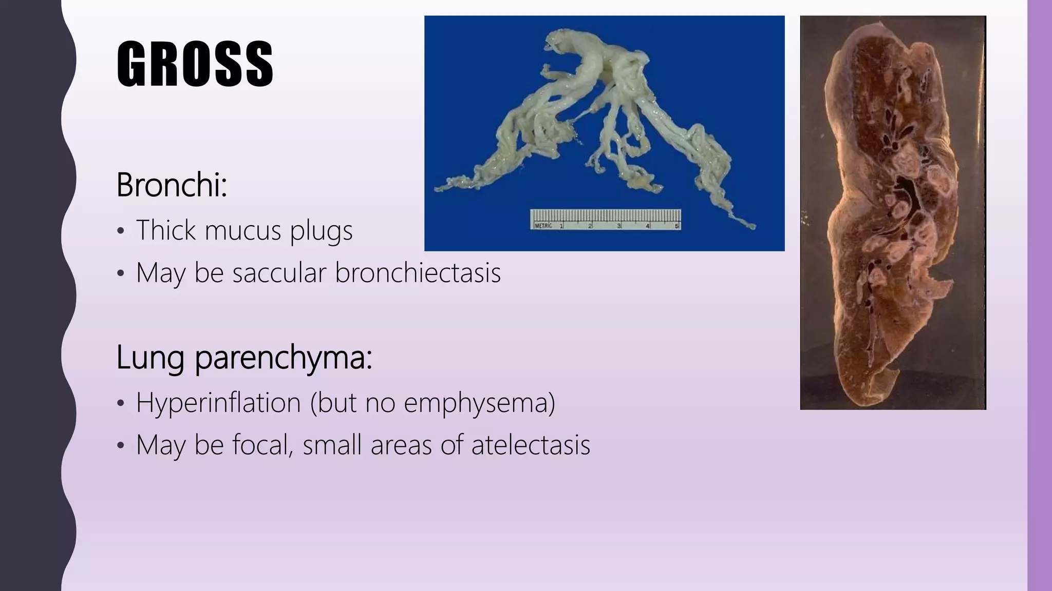 GROSS
Bronchi:
• Thick mucus plugs
• May be saccular bronchiectasis
Lung parenchyma:
• Hyperinflation (but no emphysema)
• May be focal, small areas of atelectasis
 