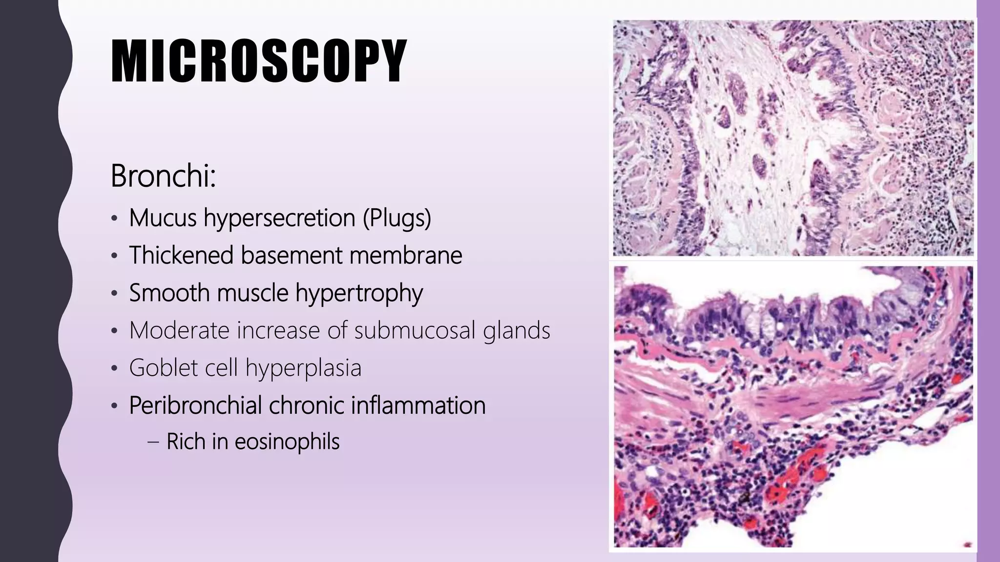 MICROSCOPY
Bronchi:
• Mucus hypersecretion (Plugs)
• Thickened basement membrane
• Smooth muscle hypertrophy
• Moderate increase of submucosal glands
• Goblet cell hyperplasia
• Peribronchial chronic inflammation
– Rich in eosinophils
 