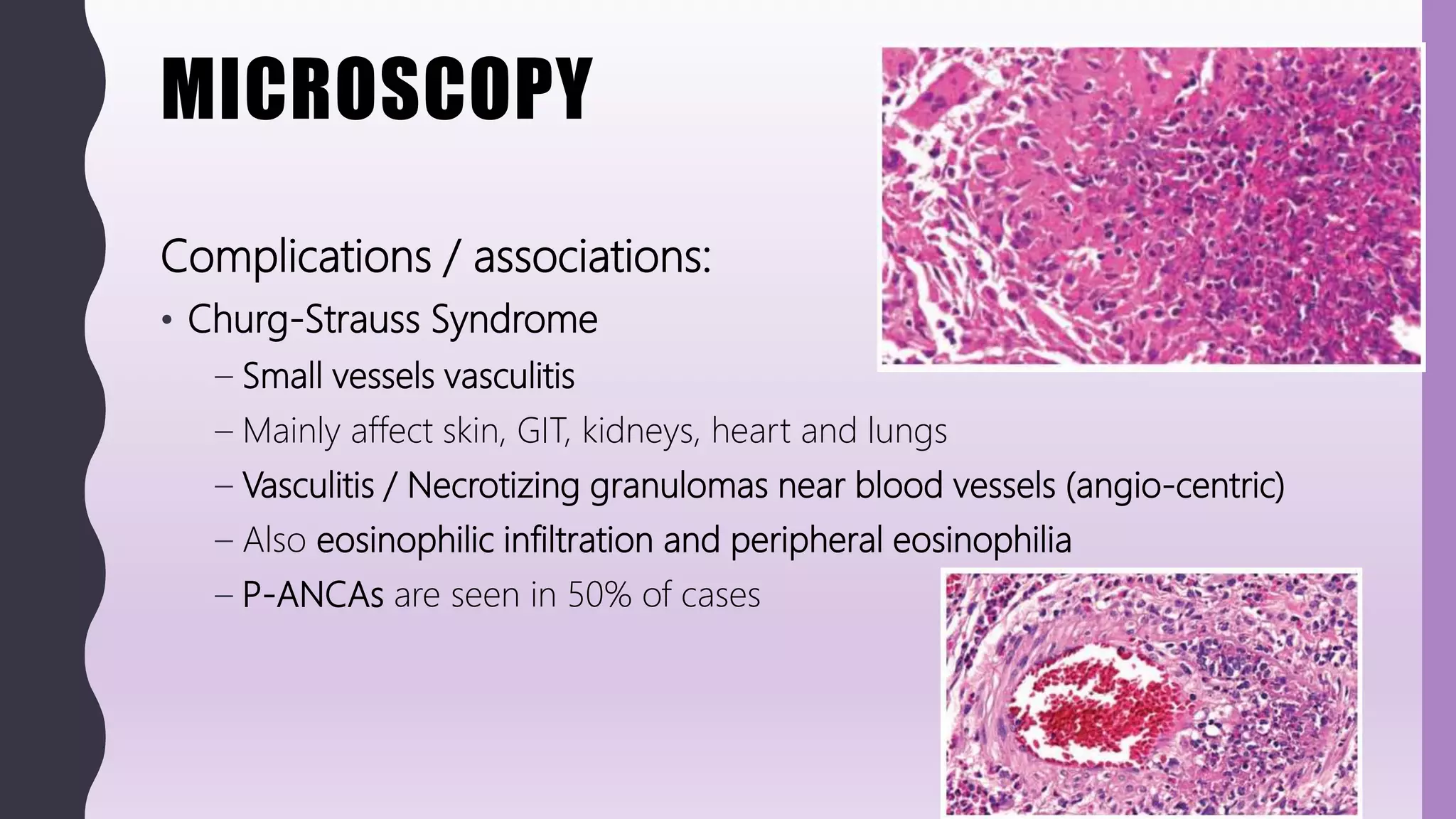 MICROSCOPY
Complications / associations:
• Churg-Strauss Syndrome
– Small vessels vasculitis
– Mainly affect skin, GIT, kidneys, heart and lungs
– Vasculitis / Necrotizing granulomas near blood vessels (angio-centric)
– Also eosinophilic infiltration and peripheral eosinophilia
– P-ANCAs are seen in 50% of cases
 