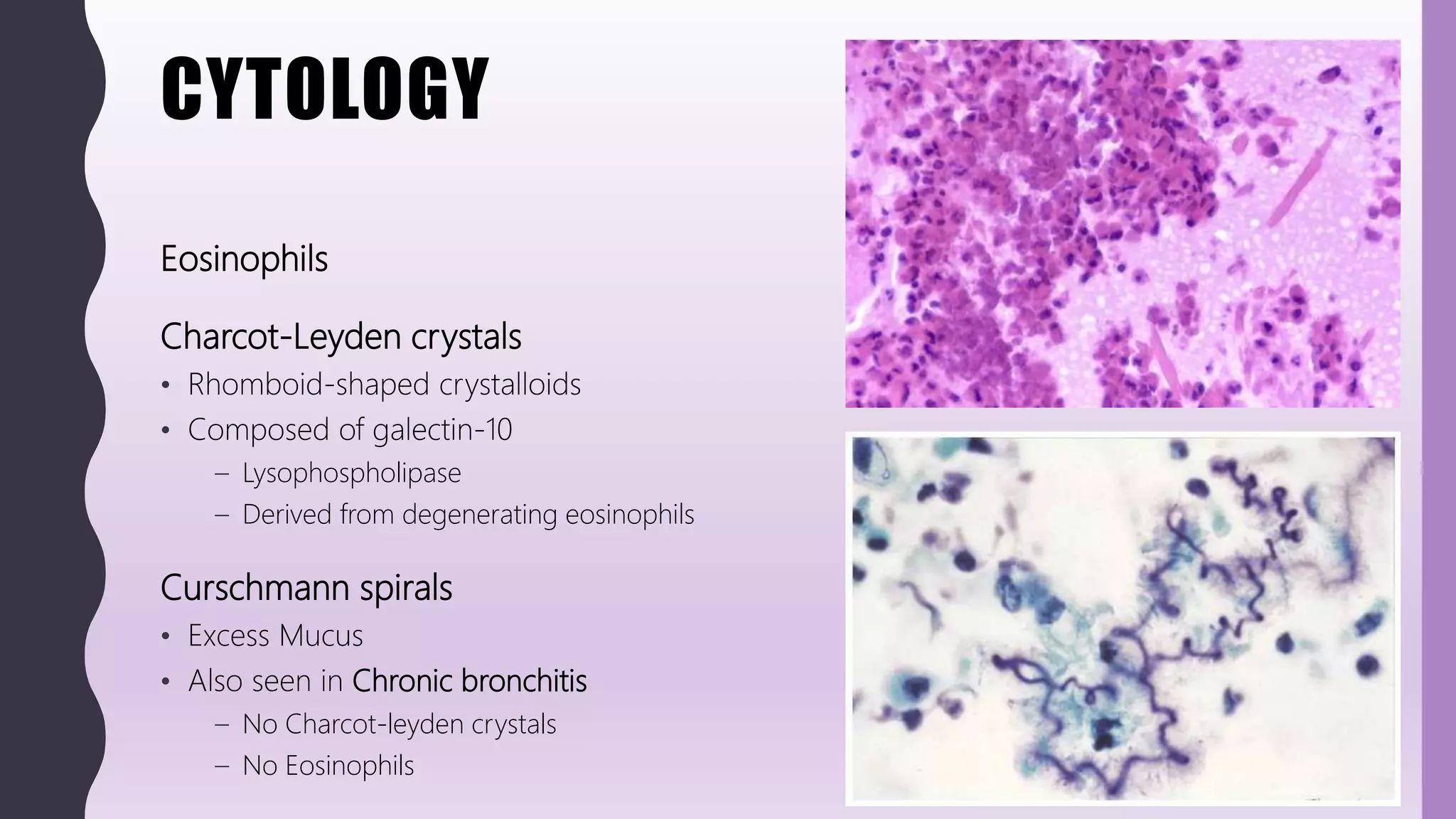 CYTOLOGY
Eosinophils
Charcot-Leyden crystals
• Rhomboid-shaped crystalloids
• Composed of galectin-10
– Lysophospholipase
– Derived from degenerating eosinophils
Curschmann spirals
• Excess Mucus
• Also seen in Chronic bronchitis
– No Charcot-leyden crystals
– No Eosinophils
 