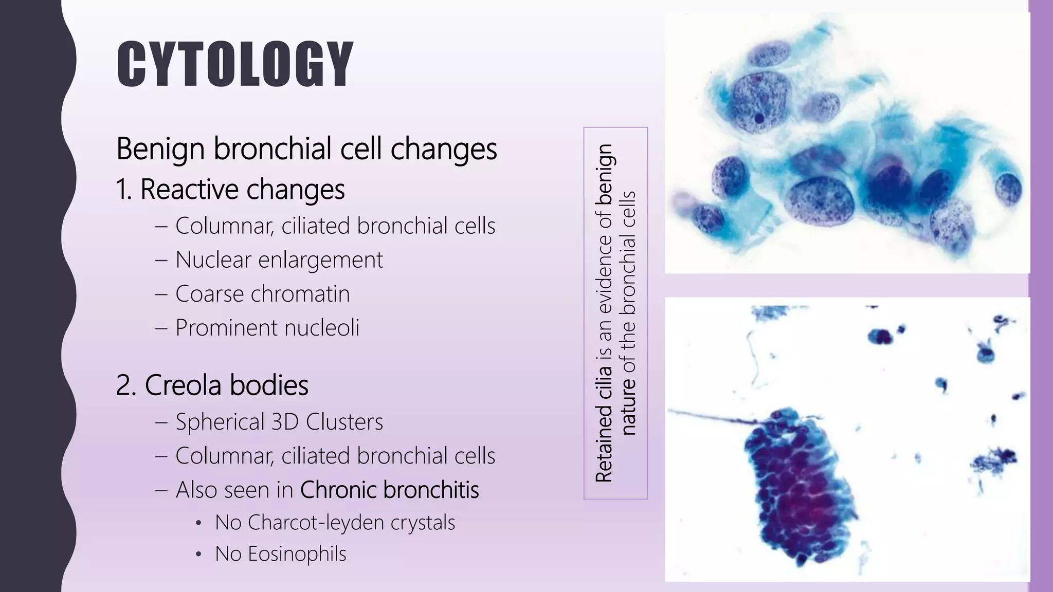 CYTOLOGY
Benign bronchial cell changes
1. Reactive changes
– Columnar, ciliated bronchial cells
– Nuclear enlargement
– Coarse chromatin
– Prominent nucleoli
2. Creola bodies
– Spherical 3D Clusters
– Columnar, ciliated bronchial cells
– Also seen in Chronic bronchitis
• No Charcot-leyden crystals
• No Eosinophils
Retainedciliaisanevidenceofbenign
natureofthebronchialcells
 