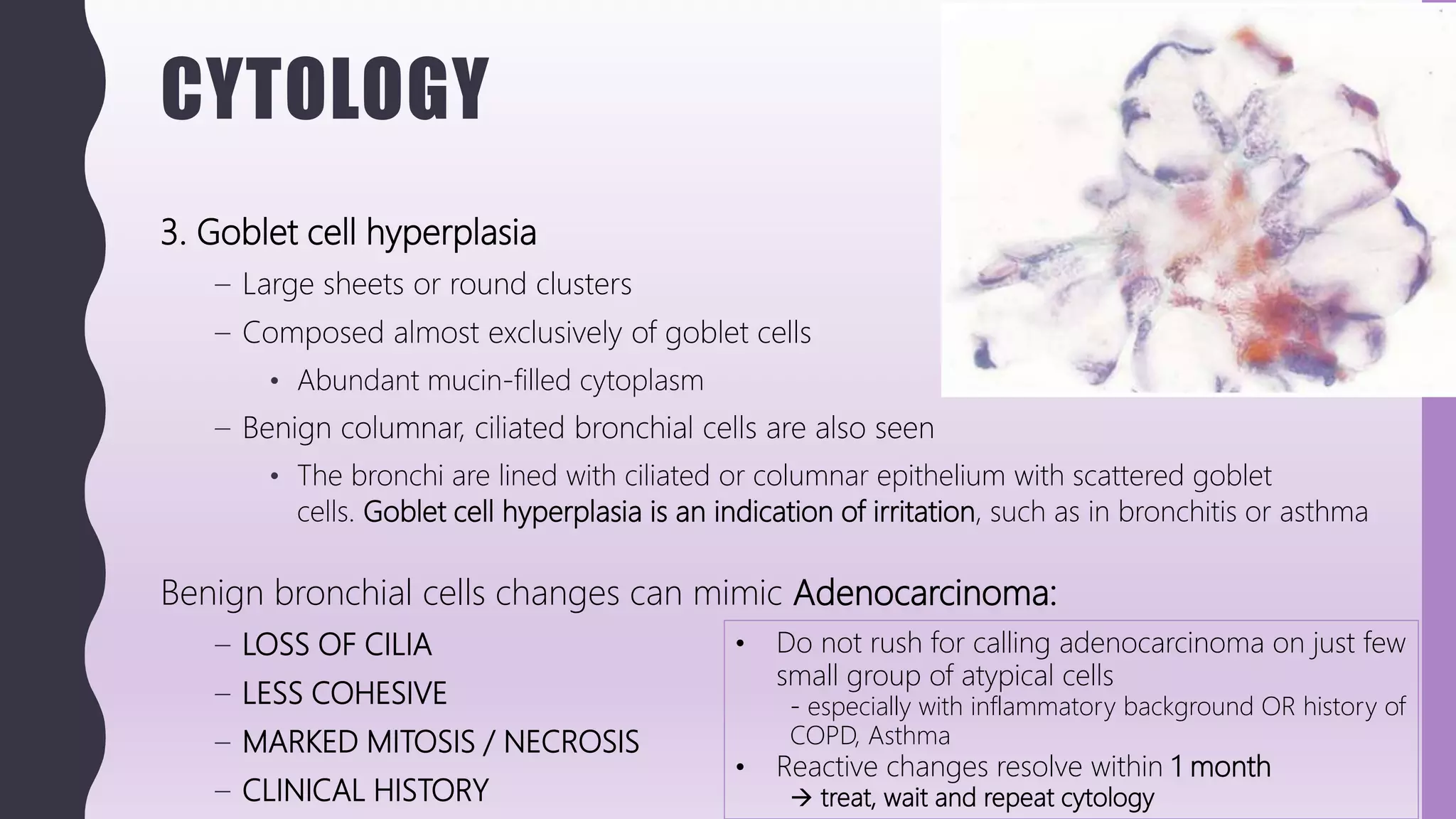 CYTOLOGY
3. Goblet cell hyperplasia
– Large sheets or round clusters
– Composed almost exclusively of goblet cells
• Abundant mucin-filled cytoplasm
– Benign columnar, ciliated bronchial cells are also seen
• The bronchi are lined with ciliated or columnar epithelium with scattered goblet
cells. Goblet cell hyperplasia is an indication of irritation, such as in bronchitis or asthma
Benign bronchial cells changes can mimic Adenocarcinoma:
– LOSS OF CILIA
– LESS COHESIVE
– MARKED MITOSIS / NECROSIS
– CLINICAL HISTORY
• Do not rush for calling adenocarcinoma on just few
small group of atypical cells
- especially with inflammatory background OR history of
COPD, Asthma
• Reactive changes resolve within 1 month
 treat, wait and repeat cytology
 