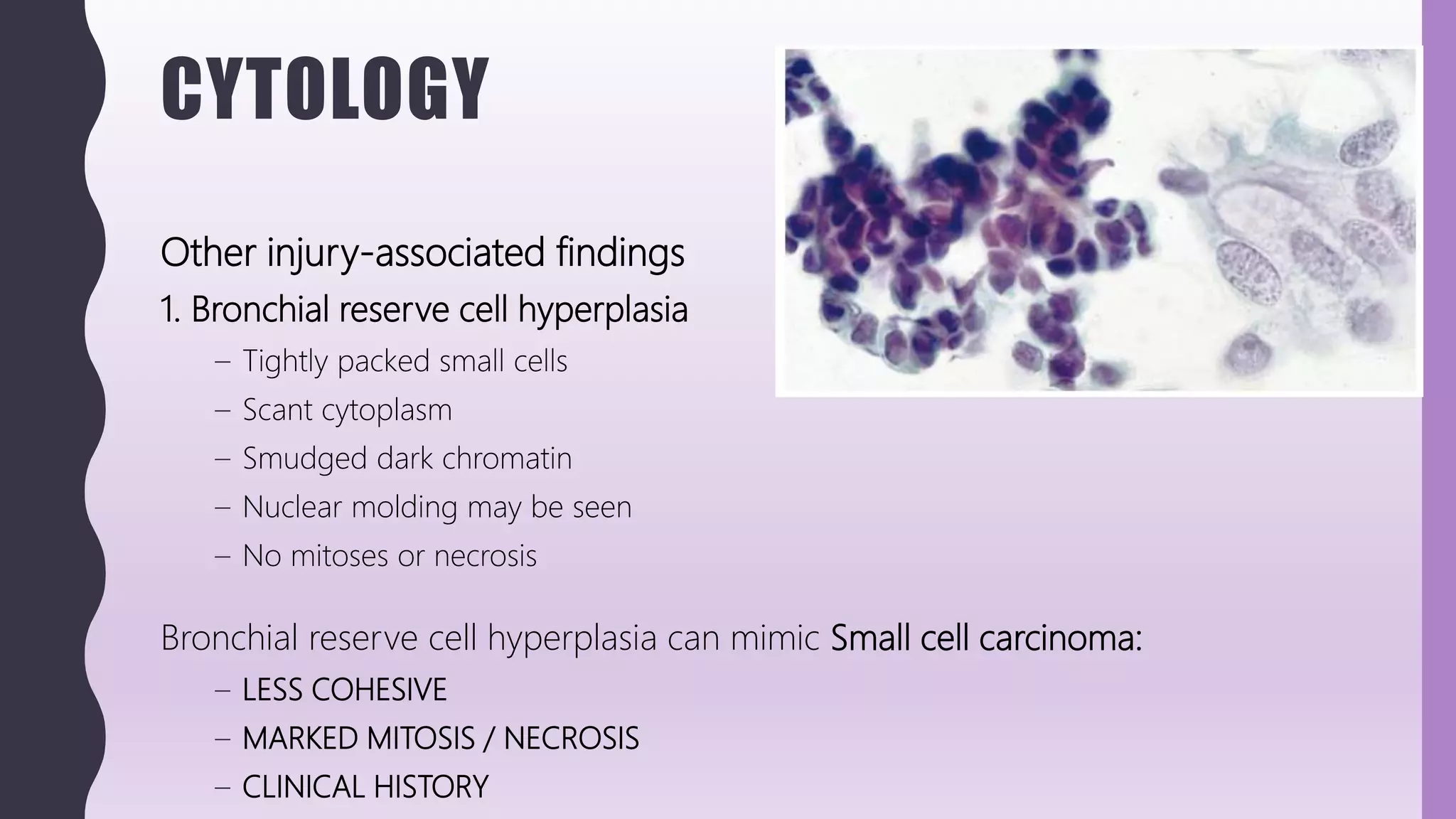 CYTOLOGY
Other injury-associated findings
1. Bronchial reserve cell hyperplasia
– Tightly packed small cells
– Scant cytoplasm
– Smudged dark chromatin
– Nuclear molding may be seen
– No mitoses or necrosis
Bronchial reserve cell hyperplasia can mimic Small cell carcinoma:
– LESS COHESIVE
– MARKED MITOSIS / NECROSIS
– CLINICAL HISTORY
 