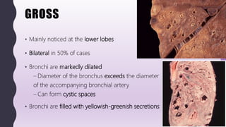 FlashPath - Lung - Bronchiectasis | PPTX