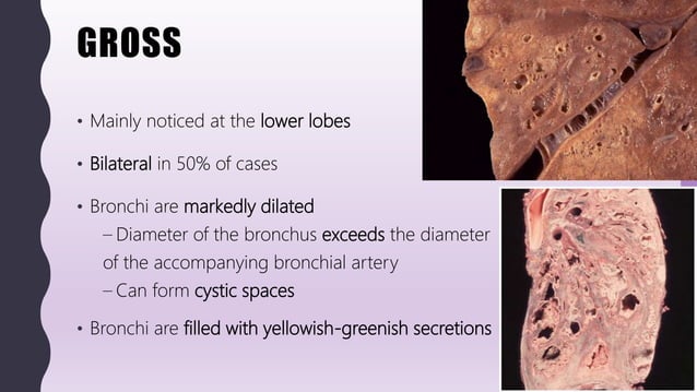 FlashPath - Lung - Bronchiectasis | PPT