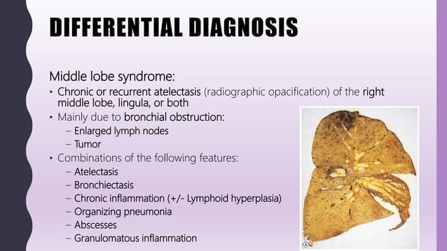 FlashPath - Lung - Bronchiectasis | PPT