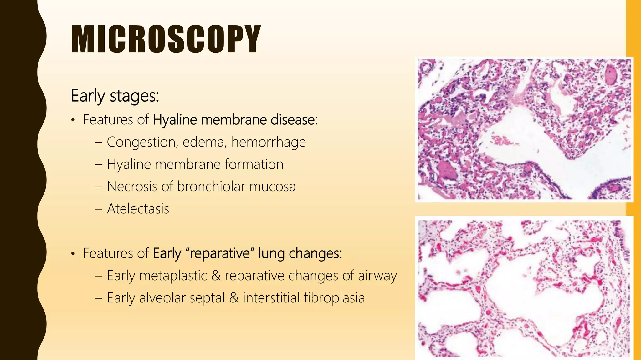 FlashPath - Lung - Bronchopulmonary Dysplasia | PPT