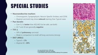 SPECIAL STUDIES
• Neuroendocrine markers
– Chromogranin, Synaptophysin, Neuron Specific Enolase, and CD56
– Atypical carcinoid may show reduced staining than Typical cases
• Pan-keratin
– Cam 5.2 is better than AE1/AE3 (to be safe, use both)
– CK 7 and 20 are generally negative
• TTF-1
– 30% of pulmonary carcinoid
– Weak in comparison to small cell lung carcinoma (strong)
• Ki67 (Mib1)
– Typical: < 2%
– Atypical: 2 – 20%
A) Lung carcinoid tumor, H&E stain
B) Synaptophysin stains the cytoplasm
C) pan-keratin shows dot-like and diffuse staining of the cytoplasm
 