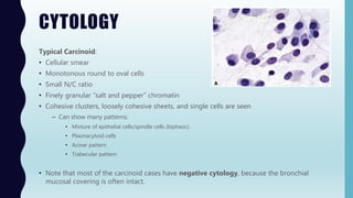 CYTOLOGY
Typical Carcinoid:
• Cellular smear
• Monotonous round to oval cells
• Small N/C ratio
• Finely granular “salt and pepper” chromatin
• Cohesive clusters, loosely cohesive sheets, and single cells are seen
– Can show many patterns:
• Mixture of epithelial cells/spindle cells (biphasic)
• Plasmacytoid cells
• Acinar pattern
• Trabecular pattern
• Note that most of the carcinoid cases have negative cytology, because the bronchial
mucosal covering is often intact.
 