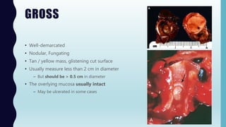 GROSS
• Well-demarcated
• Nodular, Fungating
• Tan / yellow mass, glistening cut surface
• Usually measure less than 2 cm in diameter
– But should be > 0.5 cm in diameter
• The overlying mucosa usually intact
– May be ulcerated in some cases
 