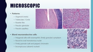 MICROSCOPIC
• Patterns:
– Organoid (nests)
– Trabeculae / Cords
– Rosette-like
– Pseudo-glandular
– Pseudo-papillary
• Bland neuroendocrine cells:
– Polygonal cells with eosinophilic (finely granular) cytoplasm
– Round to oval monotonous nuclei
– Finely granular (salt and pepper) chromatin
– Inconspicuous (absent) nucleoli
 